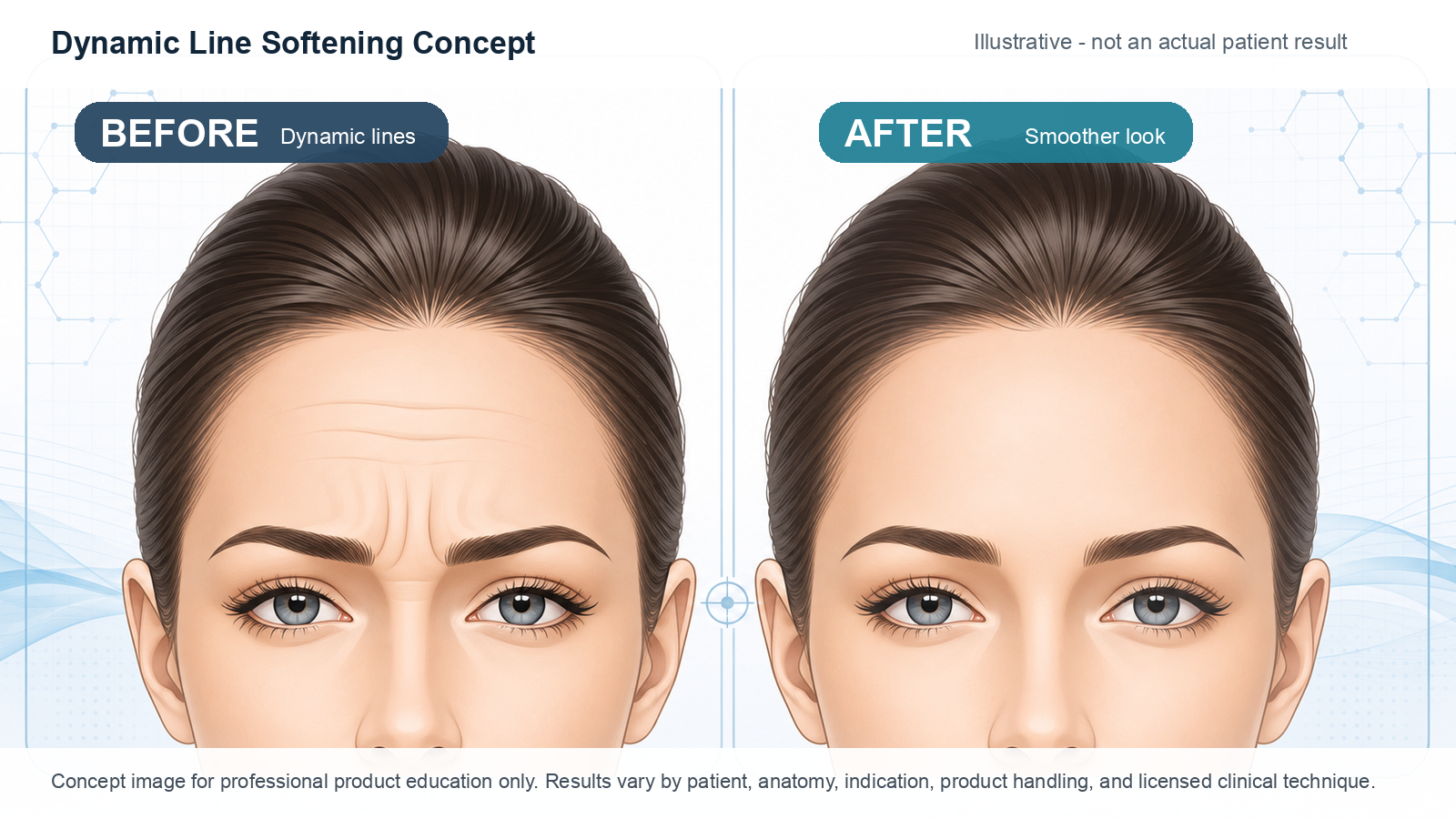 Rentox 200U dynamic line softening concept illustration - not actual patient result